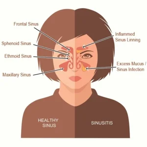 Ear Nose Throat Specialists, PC -  - Ear Nose Throat Specialists, PC -  - Blocked ears - Dr. Goldberg - Understanding the Difference between Sinusitis and Rhinitis -  - Dr. Goldberg - ENT Blog - Ear Nose Throat Specialists, PC - 