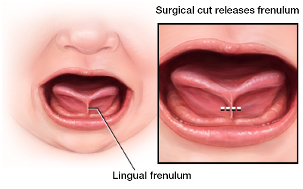 Ear Nose Throat Specialists, PC -  - Tongue tie - Dr. Goldberg - Tongue Tie Release Treatment | Improve Speech & Feeding - 