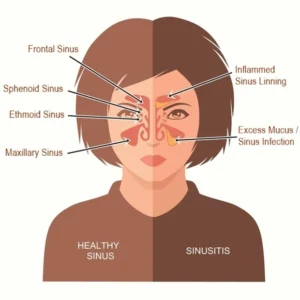 Ear Nose Throat Specialists, PC -  - Blocked ears Sinusitis and Rhinitis - Dr. Goldberg - Is Sinusitis and Rhinitis the Same? | Key Differences - Page 2 - 