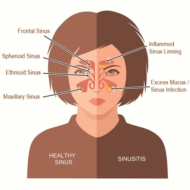 Blocked ears Sinusitis and Rhinitis