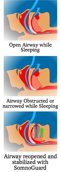 Philadelphia Snoring Center - Ear Nose Throat | Facial Plastic Surgery