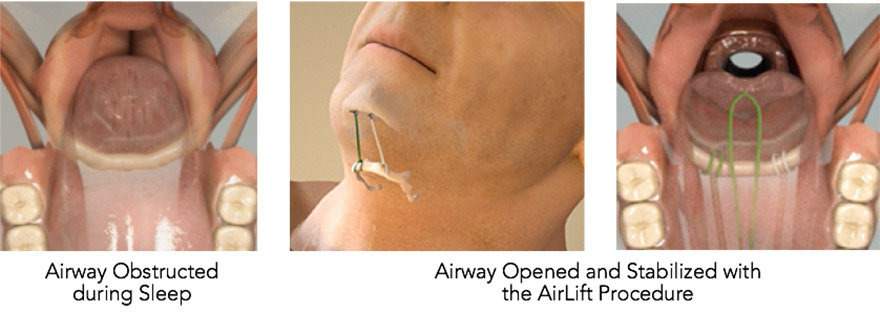 AirLift Procedure for Sleep Apnea