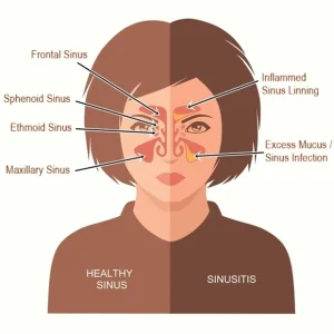 Ear Nose Throat Specialists, PC -  - Ear Nose Throat Specialists, PC -  - Blocked ears - Dr. Goldberg - Understanding the Difference between Sinusitis and Rhinitis - Page 2 -  - Dr. Goldberg - ENT Blog - Ear Nose Throat Specialists, PC - Page 2 - 